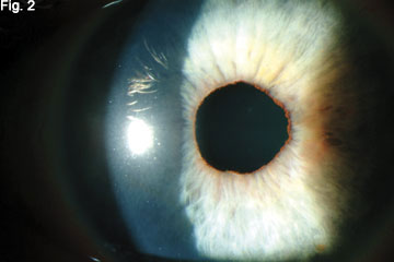 At the Slit Lamp 2