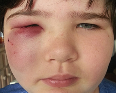 Closeup of a boy's face, with a bruised cheek and one eye swollen shut after being hit with a baseball.