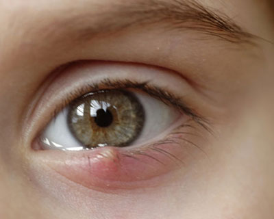 Photograph of a stye on a young woman's lower left eyelid