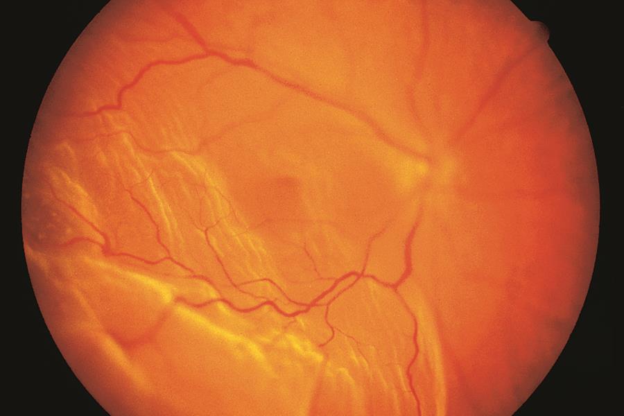 День сетчатки. Нерегматогенная отслойка сетчатки. Отслойка сетчатки глазное дно. Экссудативная отслойка сетчатки.