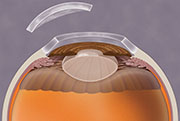 Removal of disease cornea during transplant