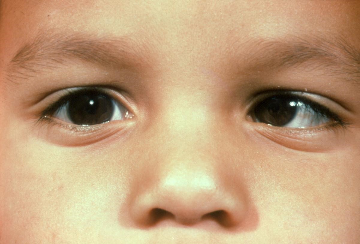 Strabismus Infantile Esotropia American Academy Of Ophthalmology