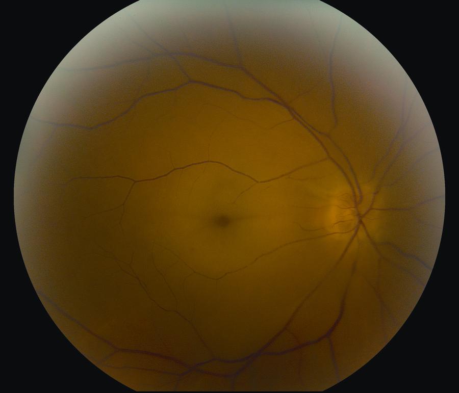 Central retinal artery occlusion - American Academy of Ophthalmology