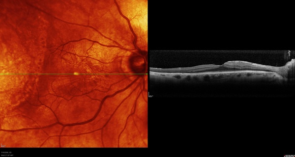 Macula of Case 2.