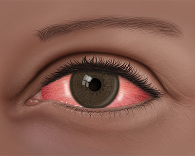 An illustration of a red, burning eye caused by ocular rosacea