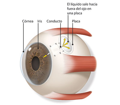 Imagen del líquido acuoso que sale del ojo sobre la placa de implante en la parte blanca del ojo