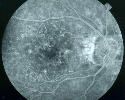 Photograph of the retina of a patient with Dry Macular Degeneration