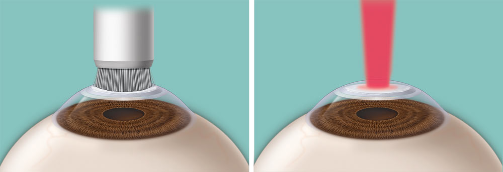 With photorefractive keratectomy (PRK), a special brush may be used to remove the outermost layer of the cornea (left); a laser removes tissue from the cornea to reshape it (right).