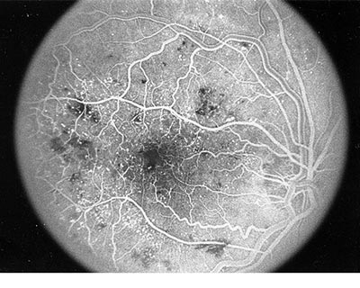 La angiografía de fluoresceína es una foto de la retina que puede revelar la presencia de vasos sanguíneos anormales.