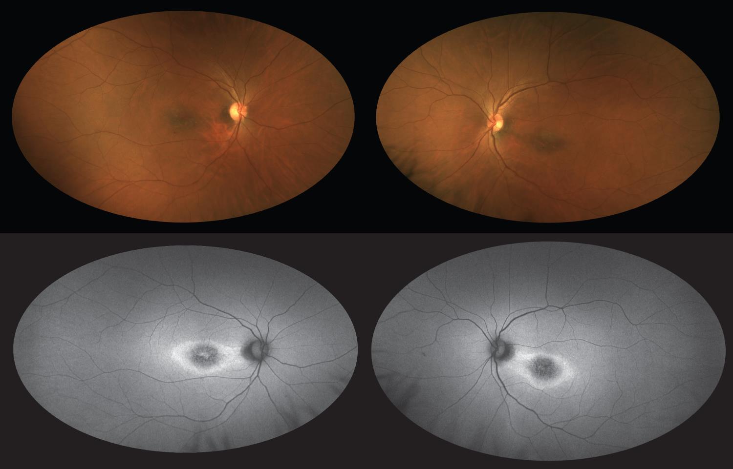 new research on retinitis pigmentosa