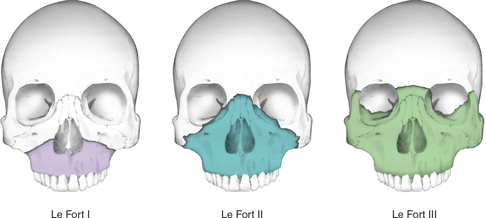 Maxillary Fracture Classification