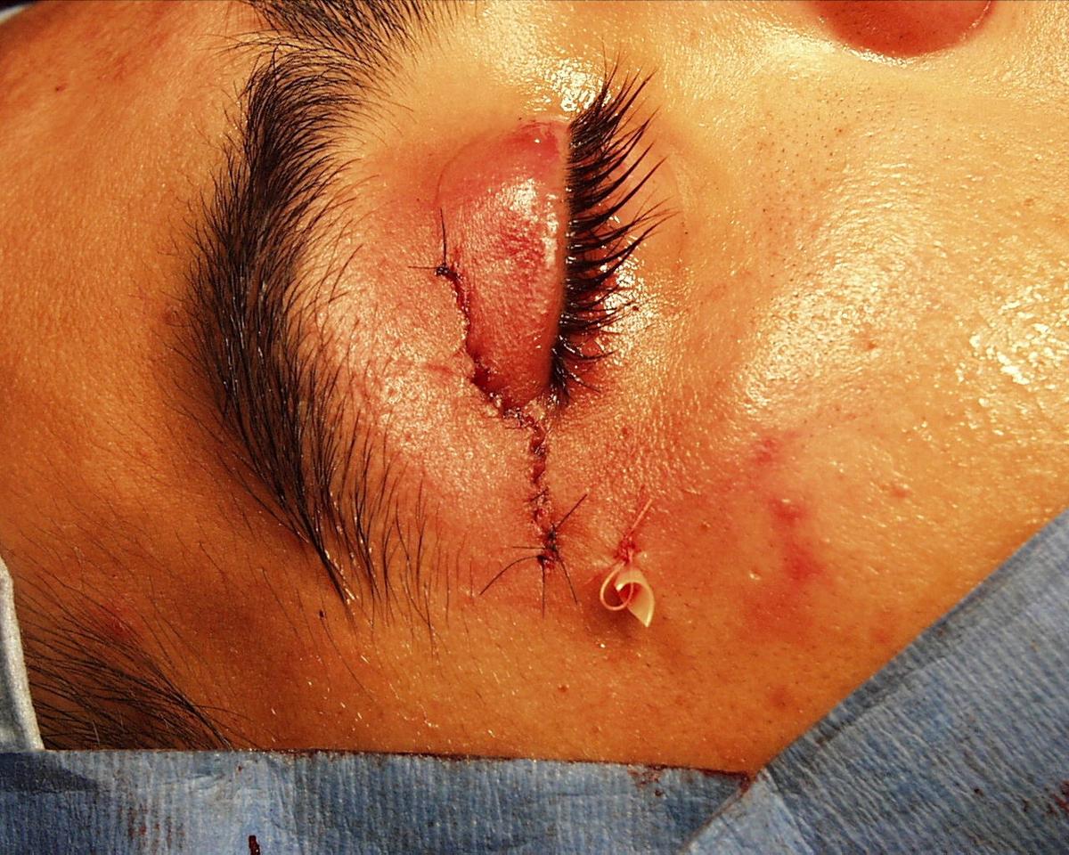 Lacrimal gland BMT closure - American Academy of Ophthalmology
