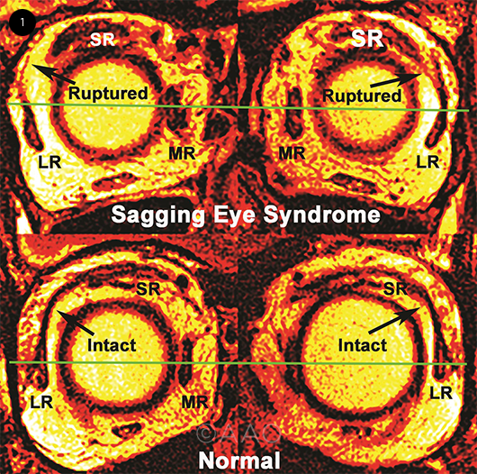 Sagging Eye Syndrome