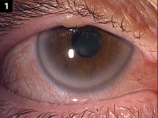 Generalized injection of bulbar conjunctiva