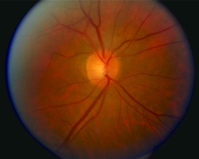 Normal optic disc and blood vessels seen in retina image.
