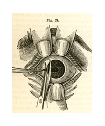 A drawing of a human eye during a surgery. The eye is being held open by two fingers on the top and one on the bottom, and there is a small knife and a small pair of scissors cutting out a small piece of the iris of the eye.