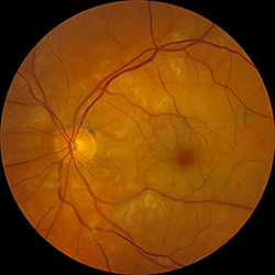 Acute Central Retinal Artery Occlusion