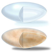 Illustration comparing two lenses from eyes. The top lens is clear, like a healthy, normal lens. The bottom lens is clouded by a cataract.
