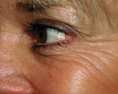 Photograph of eye wrinkles before Botox
