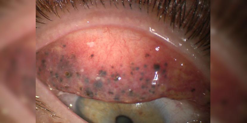 Closeup of the inside of a woman's eyelid, showing mascara buildup from years of improper use.