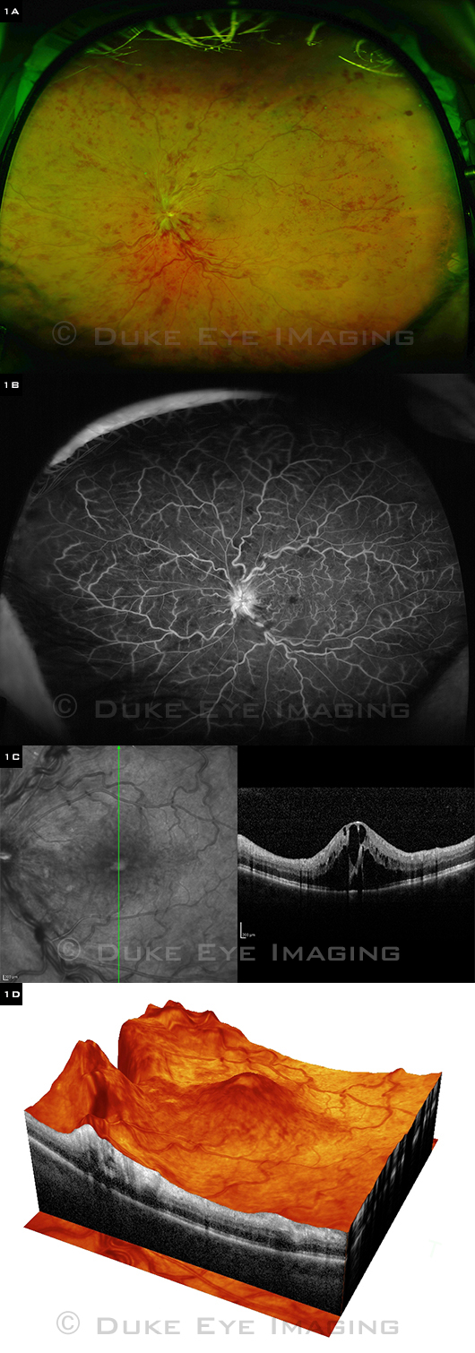 PERFUSED CRVO. Left eye of adult patient shows marked cystoid macular edema. (1A) Ultra-widefield color fundus photo. (1B) Ultra-widefield FA is ideal for evaluating peripheral retinal capillary perfusion. (1C) Vertical SD-OCT image. (1D) 3-D renderi