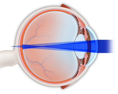 Un ojo con astigmatismo enfoca la luz de forma incorrecta. La luz se enfoca tanto delante como detrás de la retina.