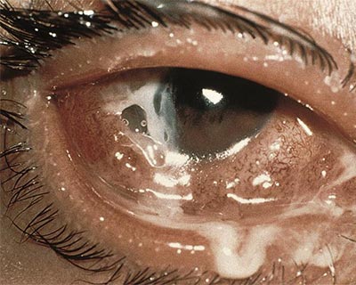 Inflammation and mucus from bacterial conjunctivitis