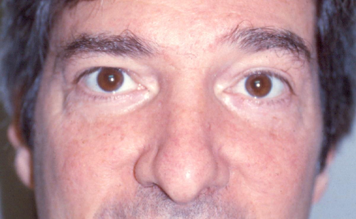 Жизнь с одним глазом. Паралитическое расходящееся косоглазие. Птоз мидриаз офтальмоплегия. Паралитическое косоглазие диплопия.