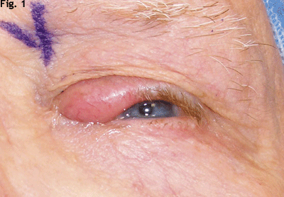 We Schedule an Eyelid Biopsy