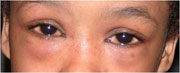 Pink eye caused by allergies (Allergic conjunctivitis)