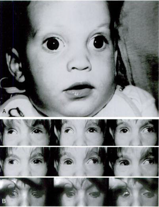 Strabismus Infantile Exotropia American Academy Of Ophthalmology