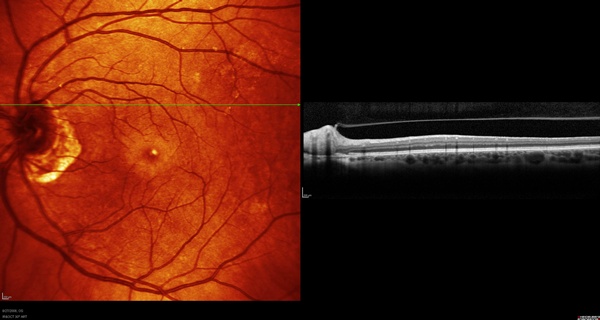 OCT image of case 5 demonstrating the presence of vitreopapillary traction syndrome.