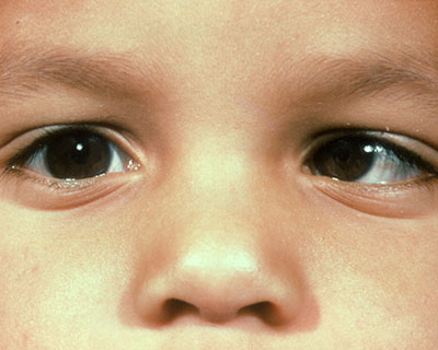 Young girl with strabismus of left eye