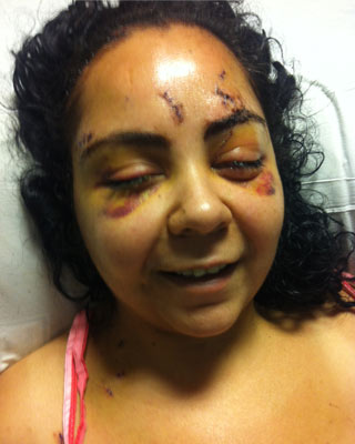 Julissa in the hospital shortly after being attacked.