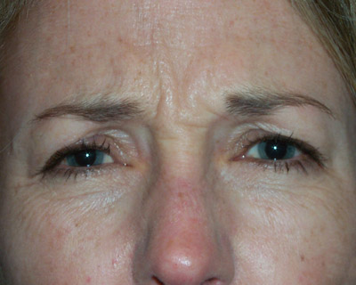 Fotografía de arrugas en la frente antes de la inyección de toxina botulínica