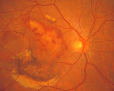Fotografía de fondo de ojo de la retina de un paciente con degeneración macular húmeda