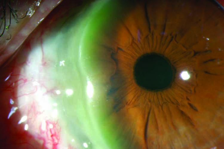 Peripheral ulcerative keratitis - American Academy of Ophthalmology