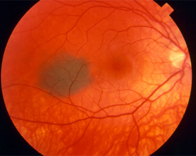 A choroidal nevus, sometimes called an eye freckle, at the back of the eye.