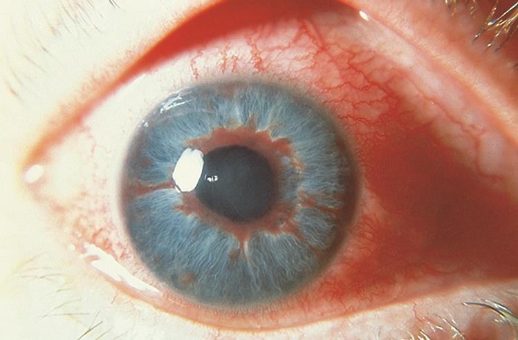 Iris neovascularization - American Academy of Ophthalmology