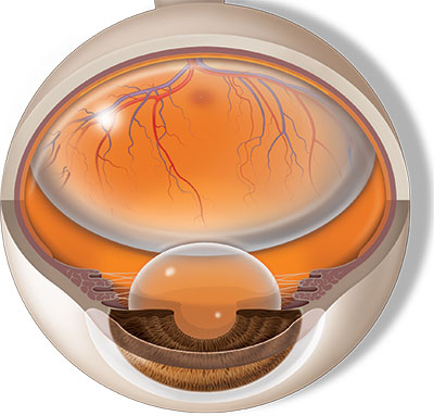 Recuperación boca abajo con burbuja de gas dentro del ojo después de la cirugía de retina