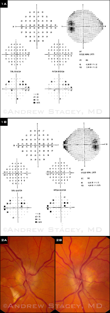 At presentation, the patient’s visual fields (1A, 1B) were abnormal, and he had bilateral optic disc edema (2A, 2B).