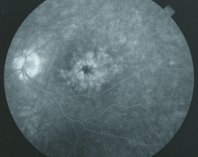 Cystoid macular edema