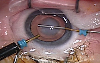 Pediatric Cataract Surgery