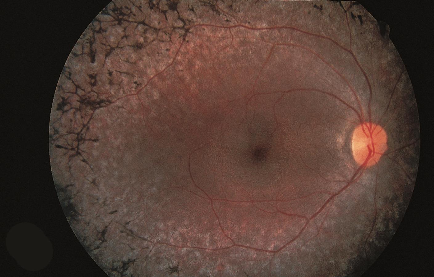 new research on retinitis pigmentosa