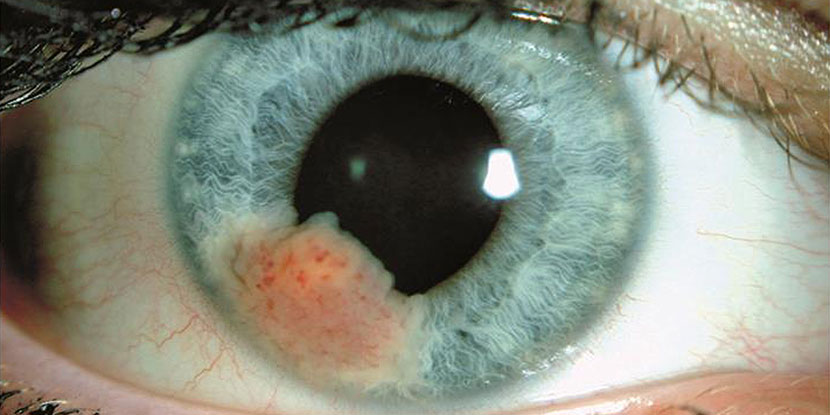 Eye Cancer - American Academy of Ophthalmology