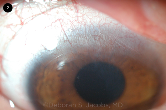 Scleral Lens