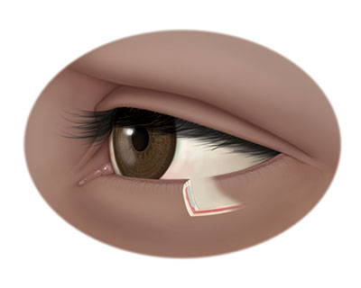Illustration of normal lower eyelid that doesn't turn inward or outward
