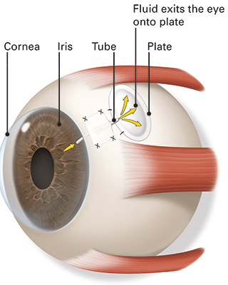 Illustration of an eye with a glaucoma drainage implant. It shows the drainage tube, plate, and how fluid exits the eye.