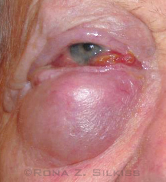 Merkel Cell Carcinoma of the Eyelid