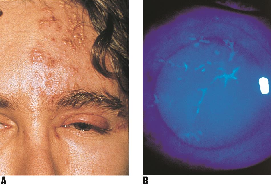 Herpes zoster ophthalmicus - American Academy of Ophthalmology